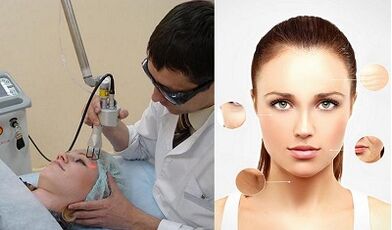 Nûvekirina çermê lazerê çawa tê kirin